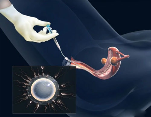 Phương pháp bơm tinh trùng vào buồng tử cung